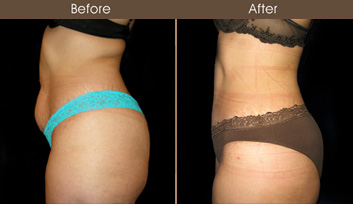 New York Tummy Tuck Before & After